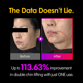 [No.1 K-Beauty Device] EMS V-Thera